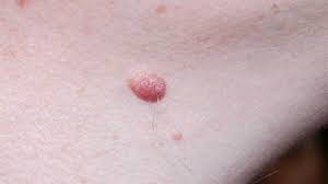 Skin Tag